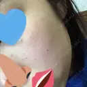 美肌レーザー / シミ取りレーザー / 美白レーザー 銀座みゆき通り美容外科 大阪梅田院 DAY 2 サムネイル用