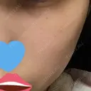美肌レーザー / シミ取りレーザー / 美白レーザー 銀座みゆき通り美容外科 大阪梅田院 DAY 5 サムネイル用