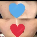 美肌レーザー / シミ取りレーザー / 美白レーザー 銀座みゆき通り美容外科 大阪梅田院 DAY 5 サムネイル用