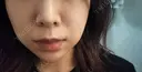 糸リフト ルラ美容クリニック 高田馬場院 DAY 28 サムネイル用