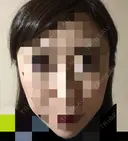 骨切り（あご） / 骨削り（エラ） / 骨削り（頬） ボンディ美容整形外科（旧リオン整形外科） DAY 119 サムネイル用