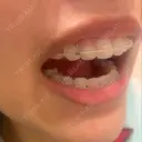 矯正（ワイヤー） ルーセント歯科・矯正歯科 DAY 224 サムネイル用