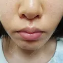 人中短縮 CLASSY 仙台美容外科・美容皮膚科 DAY 8 サムネイル用