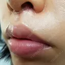 人中短縮 CLASSY 仙台美容外科・美容皮膚科 DAY 8 サムネイル用