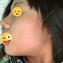 隆鼻術 / 鼻尖形成（切開） / 鼻中隔延長（切開） / 眉間プロテーゼ FROM B整形外科 (旧バウム整形外科) DAY 9 サムネイル用