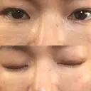 下まぶたたるみ取り セオリークリニック DAY 12 サムネイル用