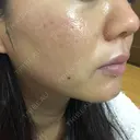 ニキビ治療 たにまちクリニック DAY 154 サムネイル用