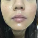 ニキビ治療 たにまちクリニック DAY 154 サムネイル用