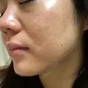 ニキビ治療 たにまちクリニック DAY 154 サムネイル用