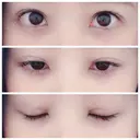 二重埋没 / 眼瞼下垂（切開） / クマ治療 / 下まぶたの脂肪取り THE MEDICAL SALON DAY 35 サムネイル用