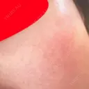 美肌レーザー / シミ取りレーザー / ルビーレーザー 銀座お肌の診療所 DAY 10 サムネイル用