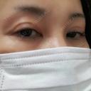 二重切開 / 眼瞼下垂（切開） / 上まぶたたるみ取り 四谷見附クリニック DAY 232 サムネイル用