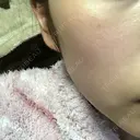 美肌レーザー / シミ取りレーザー / 美白レーザー 銀座みゆき通り美容外科 大阪梅田院 DAY 15 サムネイル用