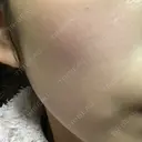 美肌レーザー / シミ取りレーザー / 美白レーザー 銀座みゆき通り美容外科 大阪梅田院 AFTER サムネイル用
