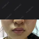 ボトックス（エラ・小顔） TCB東京中央美容外科 大宮東口院 AFTER サムネイル用