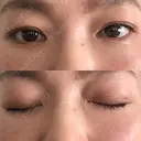 下まぶたたるみ取り セオリークリニック DAY 14 サムネイル用