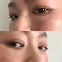 下まぶたたるみ取り セオリークリニック DAY 14 サムネイル用