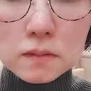 小鼻縮小（切開） / 鼻尖縮小 表参道スキンクリニック 表参道院 DAY 75 サムネイル用