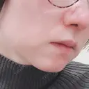 小鼻縮小（切開） / 鼻尖縮小 表参道スキンクリニック 表参道院 DAY 75 サムネイル用