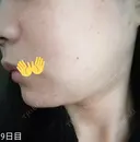 ボトックス（あご） / 肌ヒアルロン酸注入（たるみ・シワ改善） / 美容点滴・美容注射（美肌） / イオン導入 / 美肌レーザー / ニキビ治療 ラミチェ美容整形外科 DAY 9 サムネイル用