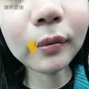 ボトックス（あご） / 肌ヒアルロン酸注入（たるみ・シワ改善） / 美容点滴・美容注射（美肌） / イオン導入 / 美肌レーザー / ニキビ治療 ラミチェ美容整形外科 DAY 32 サムネイル用