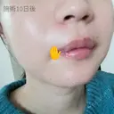 ボトックス（あご） / 肌ヒアルロン酸注入（たるみ・シワ改善） / 美容点滴・美容注射（美肌） / イオン導入 / 美肌レーザー / ニキビ治療 ラミチェ美容整形外科 AFTER サムネイル用