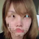 鼻尖形成（切開） / 小鼻縮小（切開） / 軟骨移植 / 眉間プロテーゼ 湘南美容クリニック 広島院 DAY 8 サムネイル用