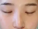 隆鼻術 / 鼻尖形成（切開） / 小鼻縮小（切開） / 軟骨移植 / 骨切幅寄せ / ワシ鼻修正・ハンプ切除 ザ・プラス美容外科 DAY 35 サムネイル用