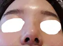 隆鼻術 / 鼻尖形成（切開） / 小鼻縮小（切開） / 軟骨移植 / 骨切幅寄せ / ワシ鼻修正・ハンプ切除 ザ・プラス美容外科 DAY 35 サムネイル用