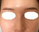隆鼻術 / 鼻尖形成（切開） / 小鼻縮小（切開） / 軟骨移植 / 骨切幅寄せ / ワシ鼻修正・ハンプ切除 ザ・プラス美容外科 DAY 39 サムネイル用