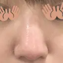 小鼻縮小（切開） 東京ヒルズクリニック 新宿院 DAY 73 サムネイル用