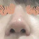 小鼻縮小（切開） 東京ヒルズクリニック 新宿院 DAY 73 サムネイル用