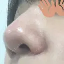 小鼻縮小（切開） 東京ヒルズクリニック 新宿院 DAY 73 サムネイル用