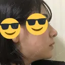 鼻尖形成（切開） / 鼻中隔延長（切開） / 小鼻縮小（切開） / 軟骨移植 / ワシ鼻修正・ハンプ切除 / 鼻尖縮小 カイ整形外科・皮膚科 DAY 8 サムネイル用