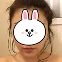 ボトックス（あご） / 脂肪溶解注射（顔） クリニックA.O. AFTER サムネイル用