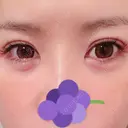 クマ治療 / 下まぶたたるみ取り / 下まぶたの脂肪取り ルラ美容クリニック 高田馬場院 DAY 7 サムネイル用