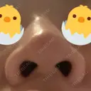 鼻尖形成（切開） / 鼻尖縮小 / ヒアルロン酸注入（鼻） 東京ヒルズクリニック 新宿院 DAY 6 サムネイル用