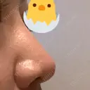 鼻尖形成（切開） / 鼻尖縮小 / ヒアルロン酸注入（鼻） 東京ヒルズクリニック 新宿院 DAY 6 サムネイル用