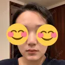 鼻尖形成（切開） / 鼻中隔延長（切開） / その他（鼻） / 軟骨移植 / ボトックス（あご） / ヒアルロン酸注入（あご） / ボトックス（エラ・小顔） / ボトックス（肩） エートップ美容整形外科 DAY 107 サムネイル用