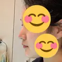 鼻尖形成（切開） / 鼻中隔延長（切開） / その他（鼻） / 軟骨移植 / ボトックス（あご） / ヒアルロン酸注入（あご） / ボトックス（エラ・小顔） / ボトックス（肩） エートップ美容整形外科 DAY 107 サムネイル用