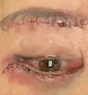 眼瞼下垂（切開） / クマ治療 / 目尻切開 / 下まぶたたるみ取り / 下まぶたの脂肪取り / タレ目形成・グラマラスライン（切開） / 眉下切開 id（アイディ）美容外科 DAY 1 サムネイル用