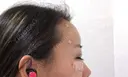 脂肪注入（額） ジュエリー美容外科 DAY 1 サムネイル用