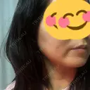 骨削り（エラ） / 骨削り（頬） / 脂肪吸引（顔） View美容整形外科 DAY 60 サムネイル用