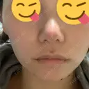 鼻尖形成（切開） / 鼻中隔延長（切開） / 小鼻縮小（切開） / 軟骨移植 HANABI整形外科 DAY 61 サムネイル用