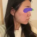 スレッドノーズ Beauty Clinic the GINZA AFTER サムネイル用