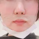 小鼻縮小（切開） / 鼻尖縮小 表参道スキンクリニック 表参道院 DAY 81 サムネイル用