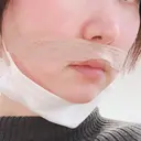 小鼻縮小（切開） / 鼻尖縮小 表参道スキンクリニック 表参道院 DAY 81 サムネイル用