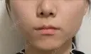 ボトックス（エラ・小顔） / 脂肪溶解注射（顔） コスメディカルクリニック シンシア 銀座院 DAY 7 サムネイル用