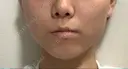 ボトックス（エラ・小顔） / 脂肪溶解注射（顔） コスメディカルクリニック シンシア 銀座院 DAY 23 サムネイル用
