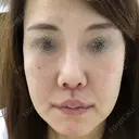 人中短縮 / 口角挙上 清潭女神美容外科 DAY 33 サムネイル用